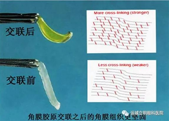 圆锥角膜最新治疗方法与研究进展
